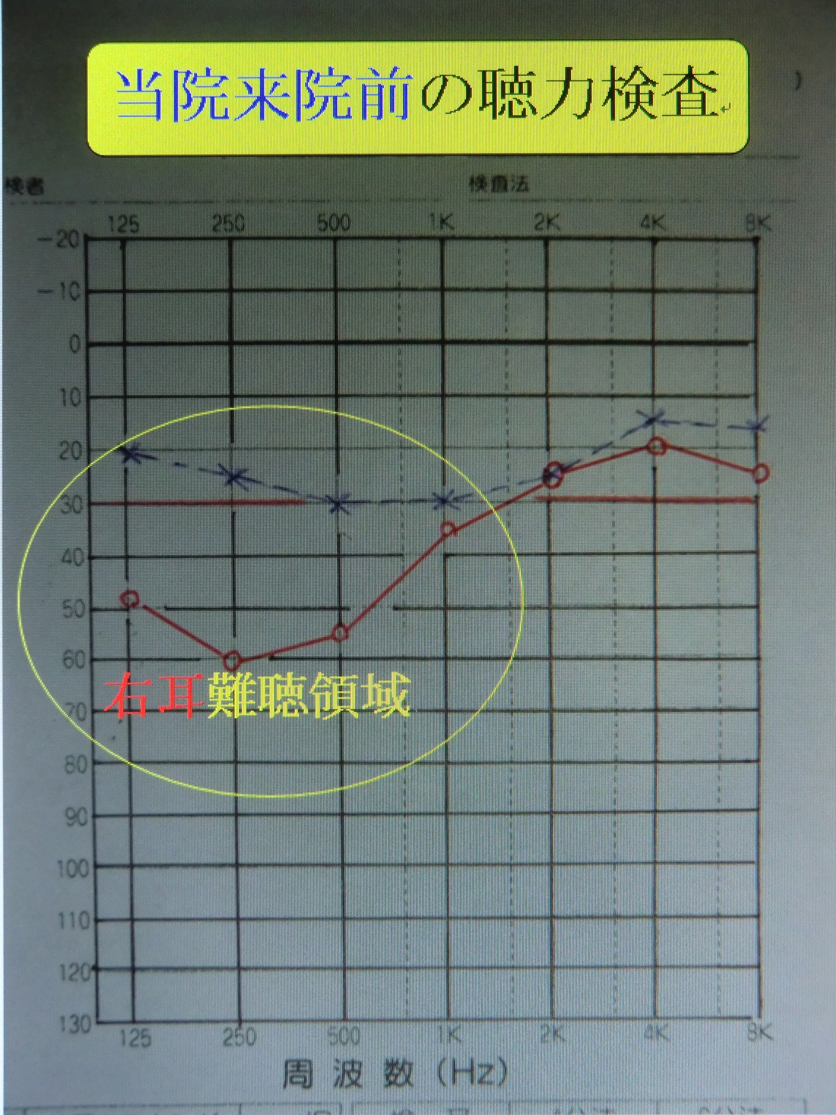 治療前　聴力検査