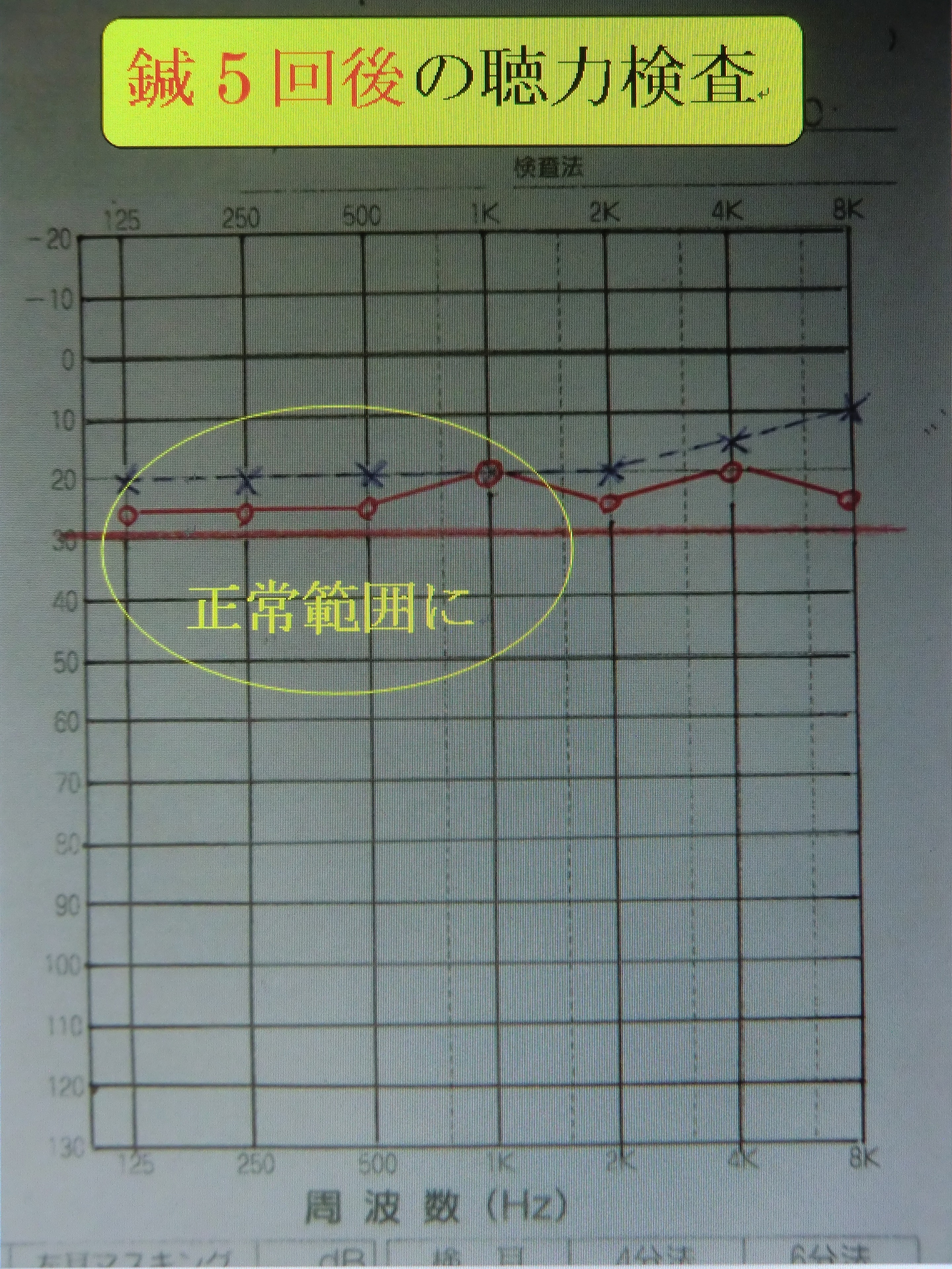 治療後　聴力検査