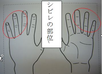 しびれ